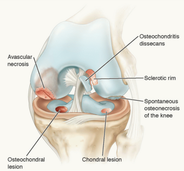 Kraakbeen      pathologie van de knie binnen de fysiotherapie
