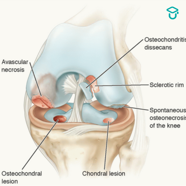 Kraakbeen pathologie van de knie binnen de fysiotherapie